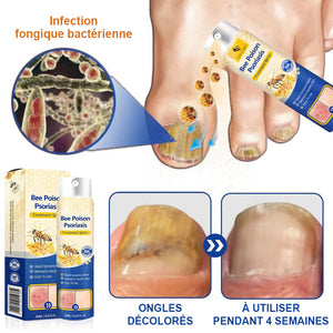 Spray contre le psoriasis au venin d'abeille