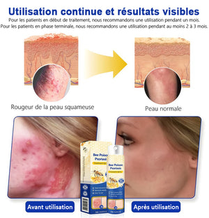 Spray contre le psoriasis au venin d'abeille