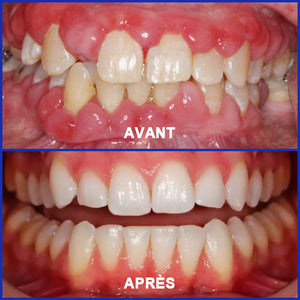 Dentifrice au venin d'abeille