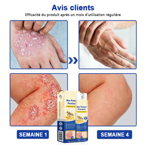 Spray contre le psoriasis au venin d'abeille