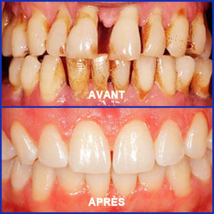 Dentifrice au venin d'abeille